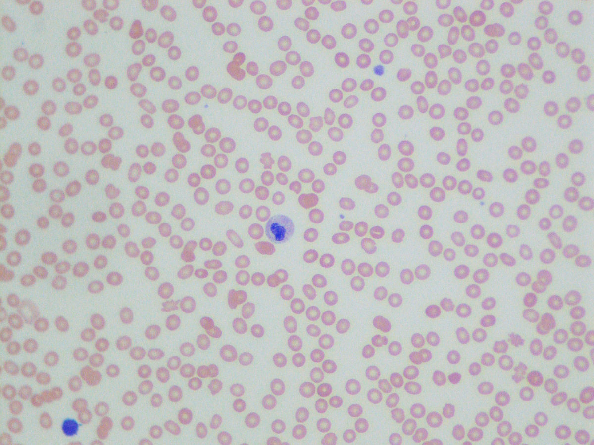 Peripheral Blood smear (GW stain)